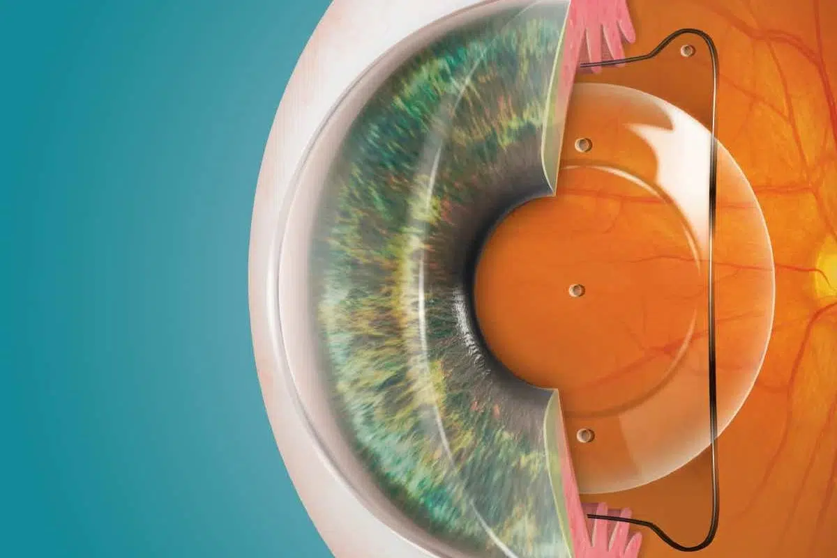 Schema einer ICL Linse im Auge - unsichtbar von aussen platziert hinter der Iris